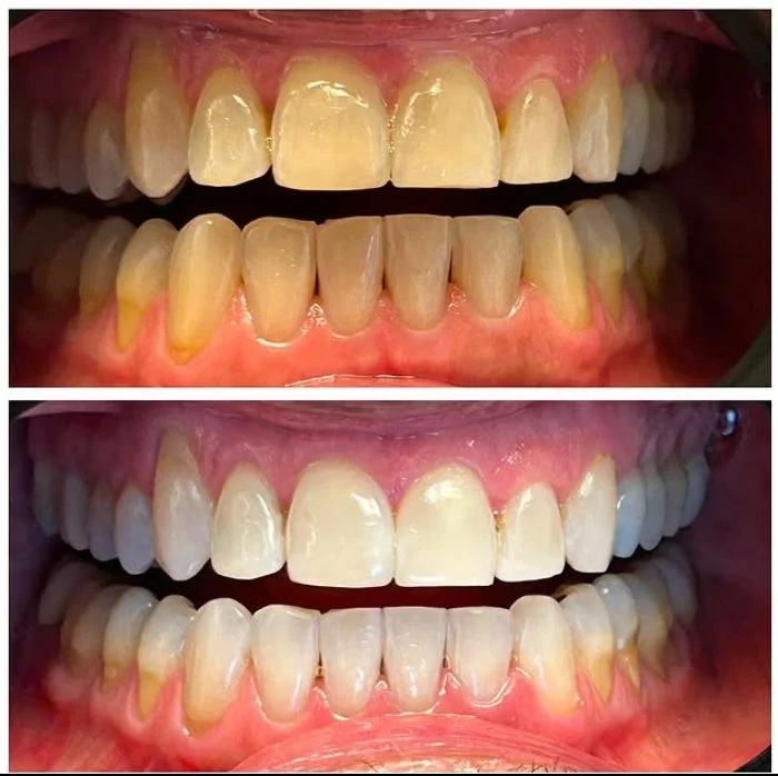 Dental Work Case 6 - Advanced Periodontal & Cosmetic Care